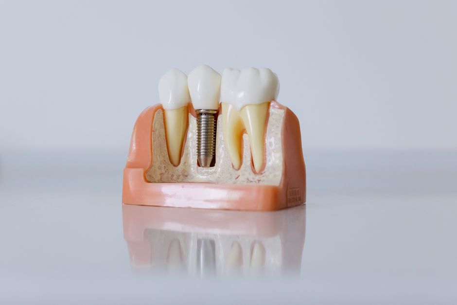 Dental implant cross-section close-up